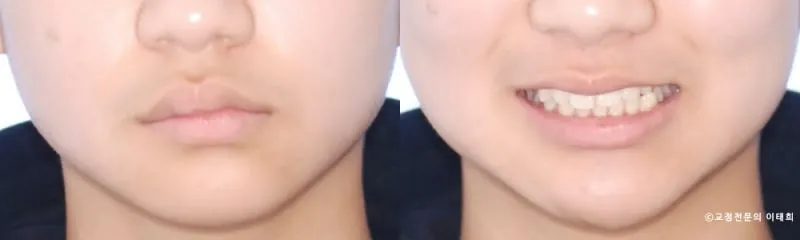 골격성 안면비대칭 일산 10대 환자, 교정으로 정중선과 반대교합을 개선한 증례