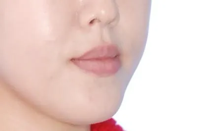 일산 성인 3급 부정교합의 비수술 교정 치료 증례