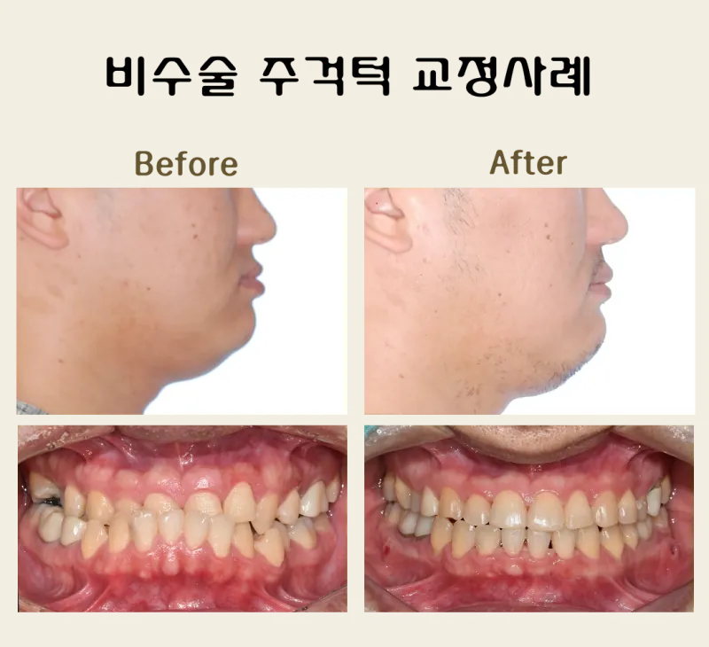 일산 직업군인 반대교합 교정 증례 | 수술 없이 교정으로 개선한 사례