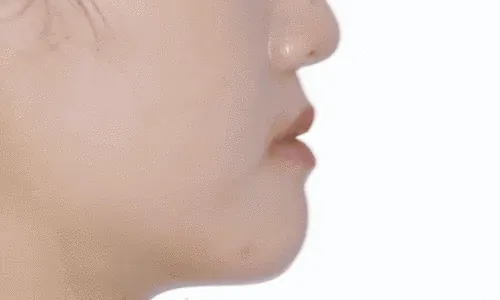 상악 앞니 이소맹출을 보인 일산 성장기 환자의 비발치 교정 증례