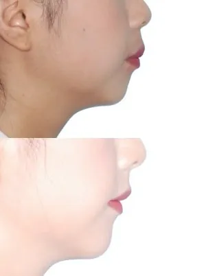 일산 10대 여학생의 전형적인 돌출입 발치교정 치료 사례