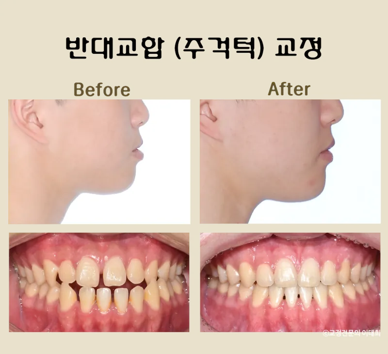일산 반대교합 교정 증례 | 하악 전돌을 스크류로 후방 이동한 사례