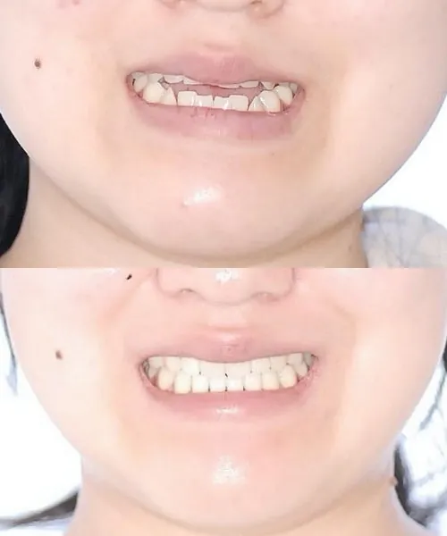 비대칭 관련 케이스 사진