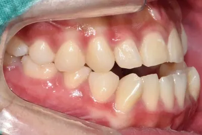 교합 상태를 보여주는 사진
