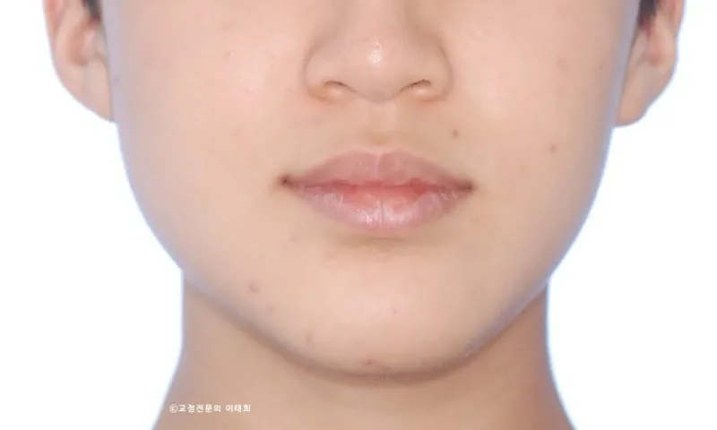 골격성 안면비대칭에서 기인한 교합의 비대칭 : 미니스크류로 개선한 일산 10대 교정 사례